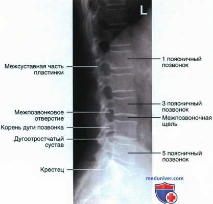 Рентгенограмма поясничных позвонков в боковой проекции
