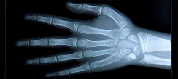 Рентген кистей рук