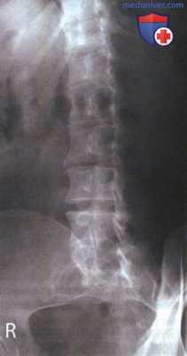 Рентгенограмма поясничных позвонков в косой ПЗ проекции