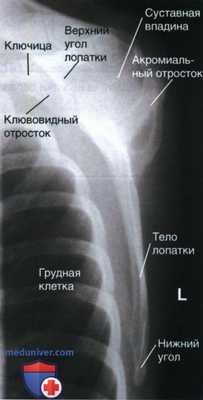 Укладка при рентгенограмме лопатки в боковой проекции (латеромедиальной, медиолатеральной)