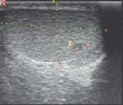 Эхографические признаки гипоэхогенного очага в паренхиме нижнего полюса правого яичка