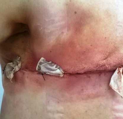 Рис. 2. Вид послеоперационной раны после применения методики бездренажной мастэктомии.