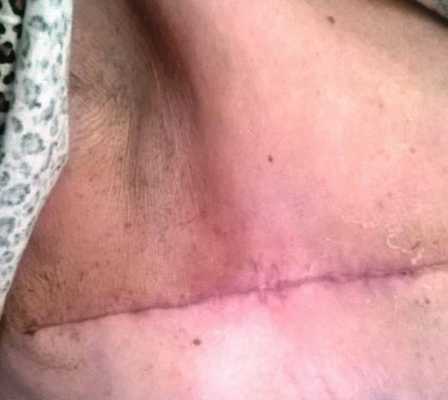 Рис. 3. Вид послеоперационной раны после применения методики бездренажной мастэктомии на 15 сутки.