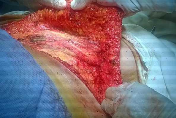 Рис. 1. Подшивание кожно-жирового лоскута к ложу подмышечно-подлопаточной клетчатки.