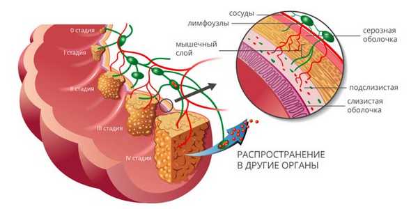 Стадии рака прямой кишки
