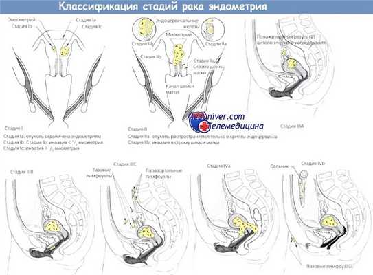 Классификация стадий рака эндометрия