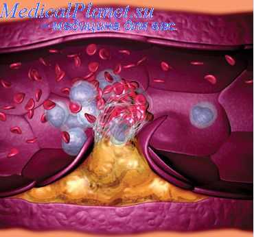 операции на сосудах