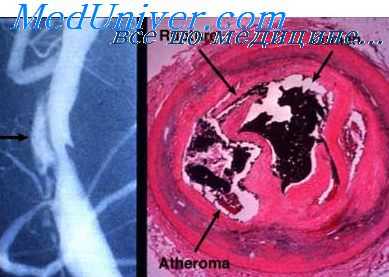 острая артериальная непроходимость