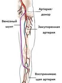 При критической ишемии связанной с поражением подколенной артерии и мелких артерий голени профундопластика не приведет к устранению критической ишемии