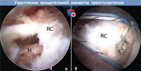Укрепление вращательной манжеты плечевого сустава трансплантатом