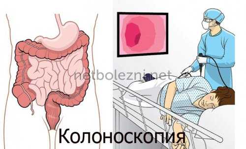 Колоноскопия для исследования кишечника