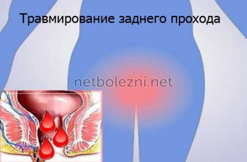 Травмирование заднего прохода