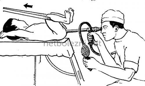 Ректороманоскопия у ребенка