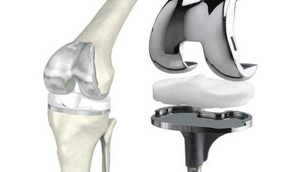 Виды эндопротезов коленного сустава