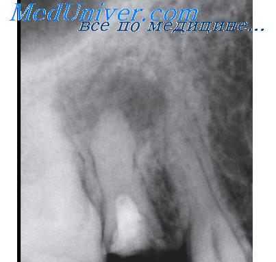 снимок зубов