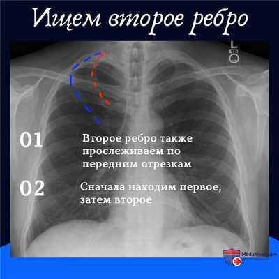 Как считать ребра на рентгенограмме грудной клетки