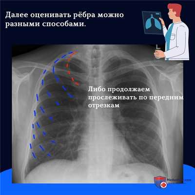 Как считать ребра на рентгенограмме грудной клетки