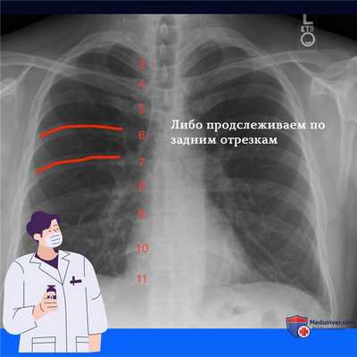 Как считать ребра на рентгенограмме грудной клетки