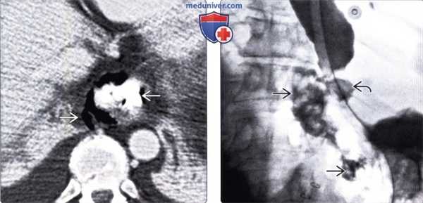 Лучевая диагностика синдрома Бурхаве