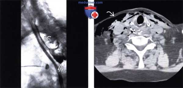 Рентгенография (эзофагография), КТ при перфорации пищевода