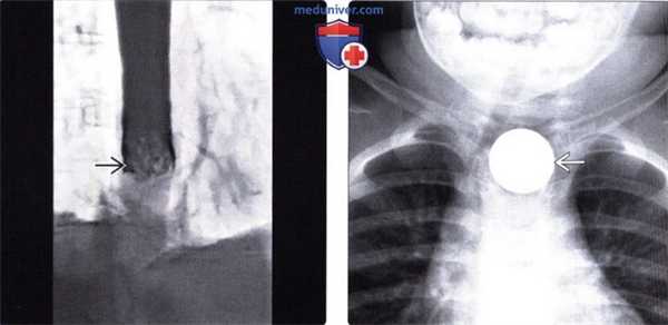 Лучевая диагностика инородного тела пищевода