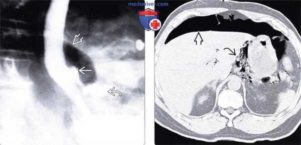 Рентгенография (эзофагография), КТ при перфорации пищевода