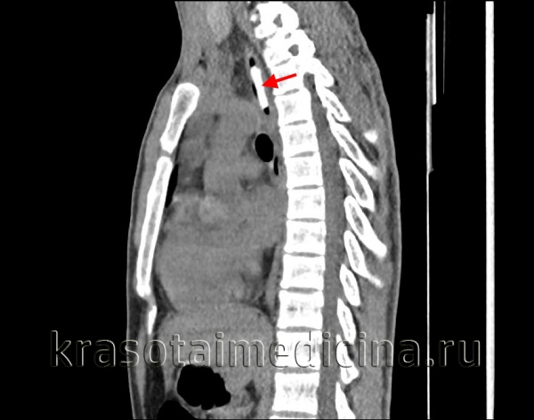 Процедура Рентген пищевода