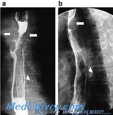 рентгенологическое исследование пищевода
