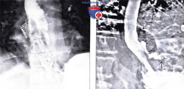 Лучевая диагностика инородного тела пищевода