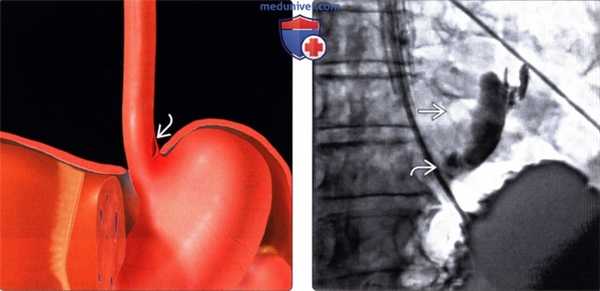 Лучевая диагностика синдрома Бурхаве