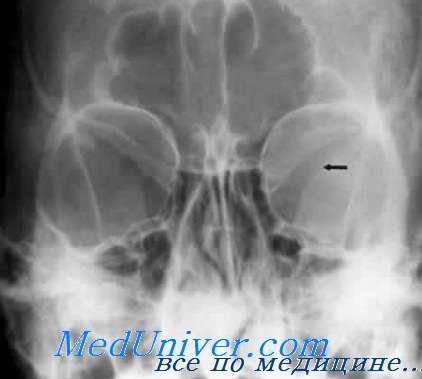 рентгенография глаза
