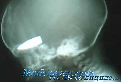 диагностика инородных тел глаза