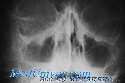 определение инородного тела глаза