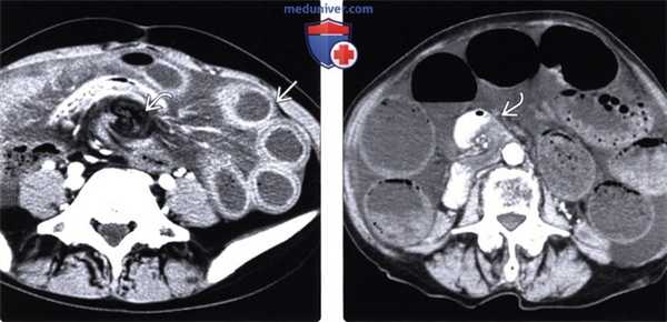 Рентгенография, КТ при чрезбрыжеечной послеоперационной грыже
