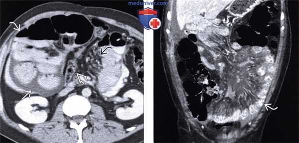 Рентгенография, КТ при чрезбрыжеечной послеоперационной грыже