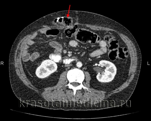 КТ органов брюшной полости. Постоперационная инцизионная грыжа передней брюшной стенки справа, содержащая часть толстой кишки