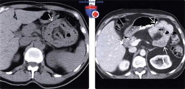 Рентгенограмма, КТ при парадуоденальной грыже