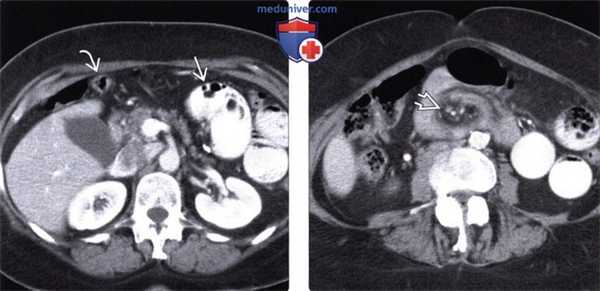 Рентгенография, КТ при чрезбрыжеечной послеоперационной грыже
