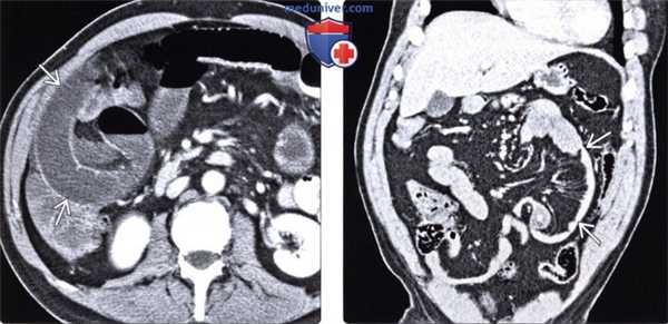 Рентгенограмма, КТ при парадуоденальной грыже
