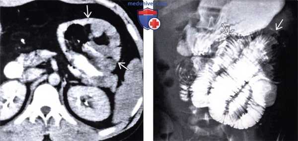 Рентгенограмма, КТ при парадуоденальной грыже