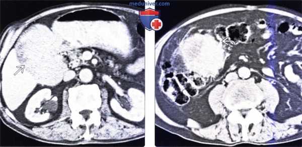 Рентгенограмма, КТ, МРТ, УЗИ, ПЭТ при гастроинтестинальной стромальной опухоли (ГИСО) желудка