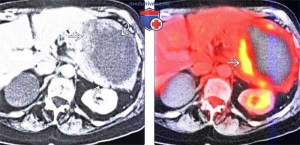 Рентгенограмма, КТ, МРТ, УЗИ, ПЭТ при гастроинтестинальной стромальной опухоли (ГИСО) желудка