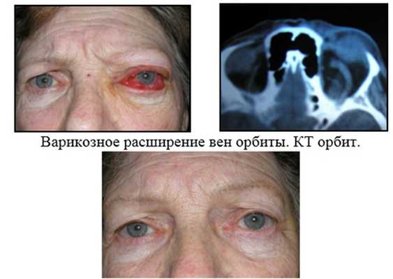 Ретробульбарный неврит