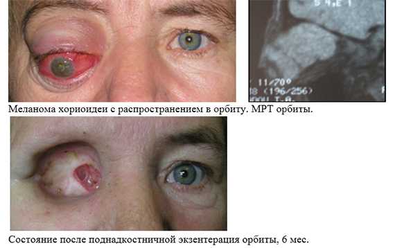 Ретробульбарный неврит