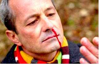 Рак гайморовой пазухи