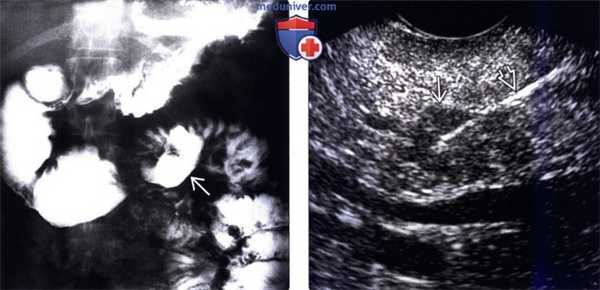 Рентгенография, КТ, МРТ, УЗИ при синдроме Золлингера-Эллисона