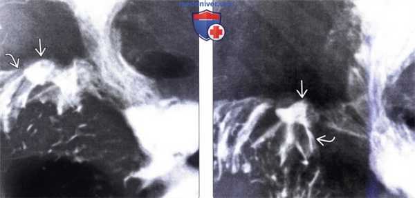 Рентгенография, КТ, МРТ, УЗИ при синдроме Золлингера-Эллисона