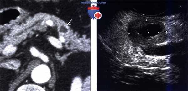 Рентгенография, КТ, МРТ, УЗИ при синдроме Золлингера-Эллисона