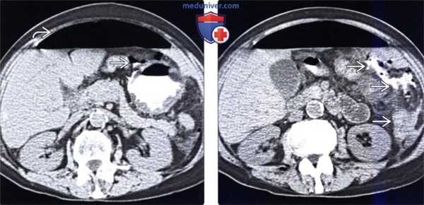 Рентгенография, КТ при язве желудка