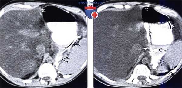 Рентгенография, КТ при язве желудка